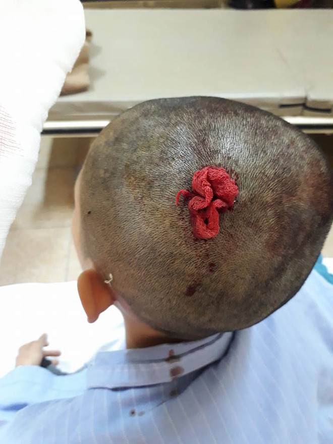 học sinh lớp 9 nhập viện nghi bị thầy giáo đánh tụ máu đầu