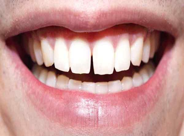 Khi nào nên niềng răng để đem lại hàm răng đẹp