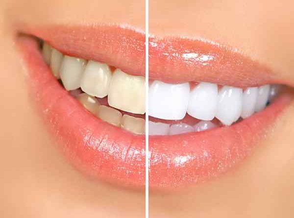 Cách làm trắng răng hiệu quả tại nhà